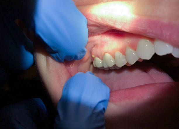 Best Emergency Wisdom Teeth Removal in East Meadow, NY