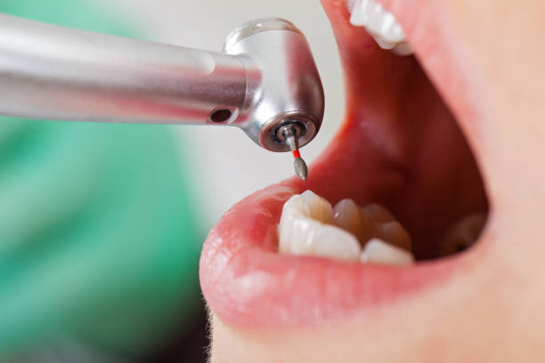 Best Emergency Treatment for Dental Infections or Abscesses in East Meadow, NY